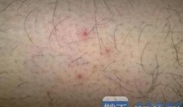 梅毒 吃瓜,吃瓜群众如何看这场健康危机