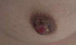 湿疹可以吃小瓜吗,湿疹患者适宜食用小瓜的探讨